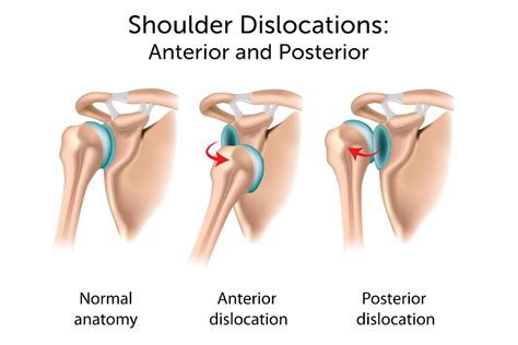 Shoulder Dislocation | Boston Children's Hospital