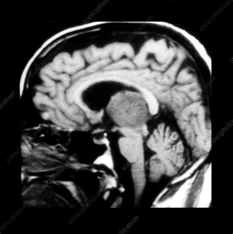 Astrocytoma, MRI - Stock Image - C007/5856 - Science Photo Library