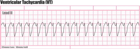 Tachycardia - Causes, Signs, Symptoms, Types, Diagnosis & Treatment