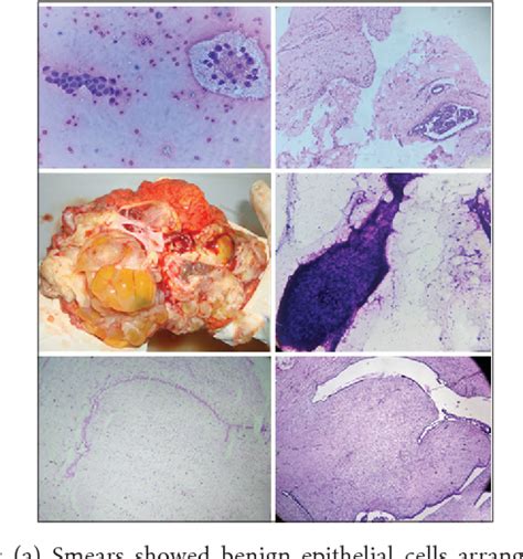 Figure 1 from Missed diagnosis of phyllodes tumor and its implications: A case report | Semantic ...