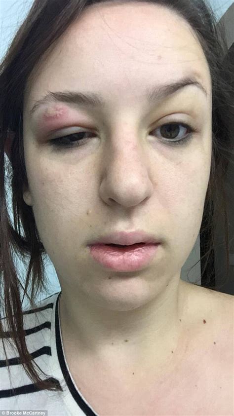 Sydney woman shares horrific pictures of infected skin after botched ...