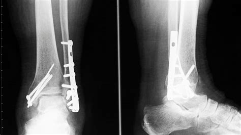 Lateral Malleolus Fracture | Lateral Malleolus Fracture Treatment