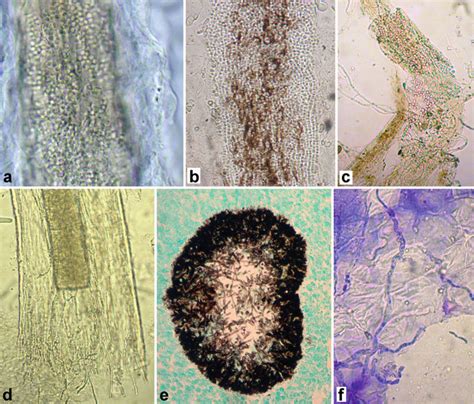 2 Laboratory diagnosis of dermatophytosis by using direct microscopic... | Download Scientific ...