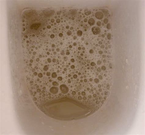 Are some bubbles in urine normal? : r/diabetes