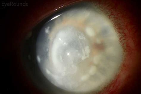 Corneal Satellite Infiltrates: Online Atlas of Ophthalmology: The ...