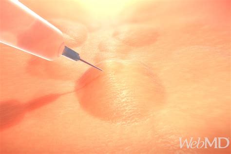 Video: Your Surgery Options for Blocked Hair Follicles | WebMD | Hair follicle, Hair, Sweat gland