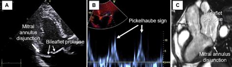 Mitral valve prolapse-related factors detected by echocardiography and... | Download Scientific ...