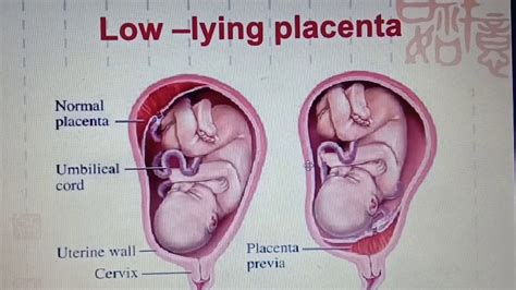 Placenta Removal After Birth