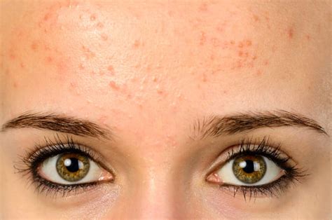 Fungal Acne: How to Know if You Have it ~ and How to Treat it