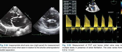 Mitral Stenosis Measurements