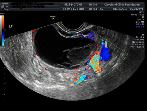 Ovarian Cysts