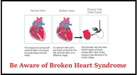 Actualizar 49+ imagem happy heart syndrome - br.thptnganamst.edu.vn