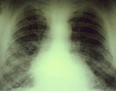 Black Lung Disease