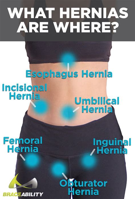 18 best Hernia Types & Treatment | Abdominal, Umbilical, and Inguinal ...