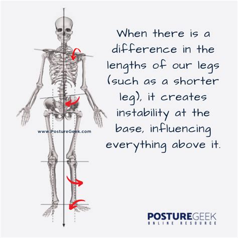 Leg Length Discrepancy - PostureGeek.com