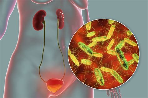 Asymptomatic bacteriuria in institutionalized elderly