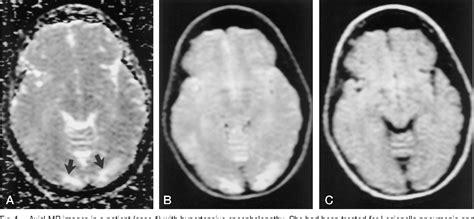 Hypertensive Encephalopathy | Semantic Scholar