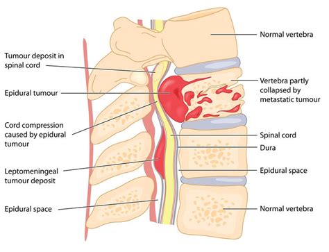 Spinal Cord Tumors in Children- Detection and Diagnosis - ACCO