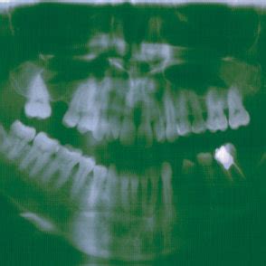 (PDF) Talon cusp: A morphological dental Anomaly