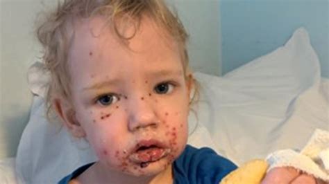 Toddler becomes infected with herpes after suspected kiss | Photo | news.com.au — Australia’s ...