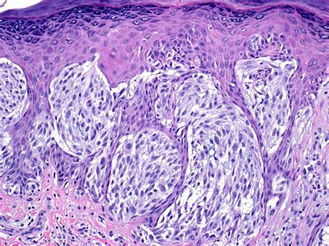 Pathology Outlines - Spitz nevus