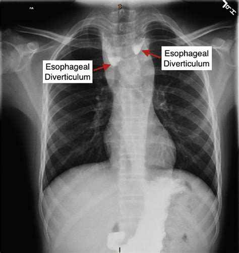 Large bilateral esophageal diverticula and esophageal narrowing at the... | Download Scientific ...