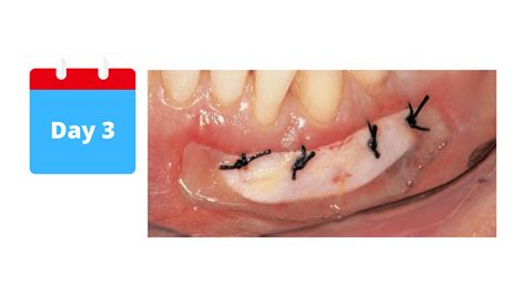 The different healing stages of a gum graft (Day by Day Pictures)