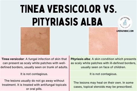 Pityriasis Alba Vs. Tinea Versicolor: Pictures and Differences