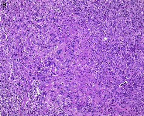 Atypical Fibroxanthoma Revisited - Surgical Pathology Clinics