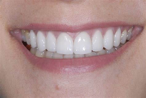 Discolored Teeth | Tetracycline Staining - Tysons Aesthetic Dentistry