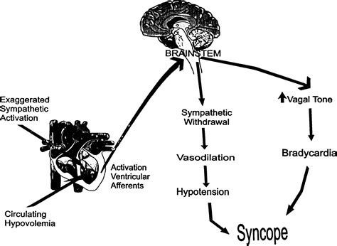 Vasovagal Syncope Disease Linked to Fainting Spells - Gazette Review