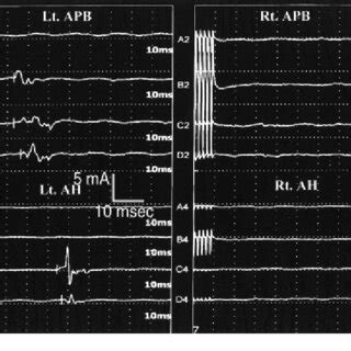 Motor-evoked potentials recorded by the surface electrodes placed on... | Download Scientific ...