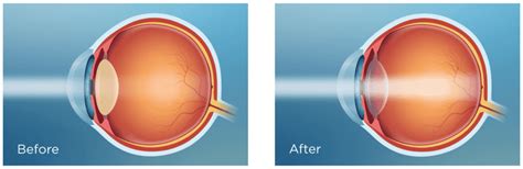 PanOptix Trifocal Lenses (IOL) for Cataract Surgery & RLE