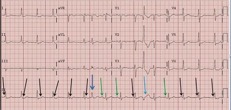 Dr. Smith's ECG Blog: AV Dissociation. Is there AV block?