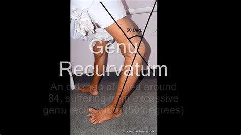 Genu Recurvatum Congenital Genu Recurvatum | atelier-yuwa.ciao.jp