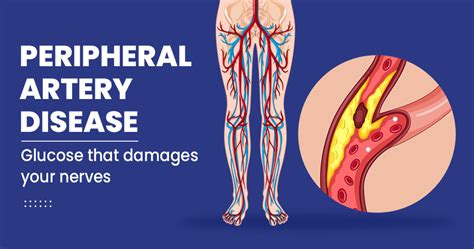 Peripheral Artery Diseases - Risk, Symptoms, Diagnosis and Treatment