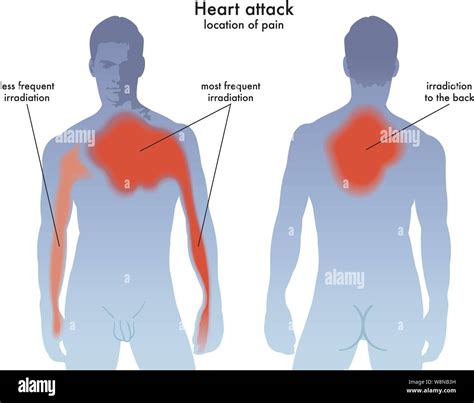 Medical illustration of the heart attack pain location Stock Vector Image & Art - Alamy