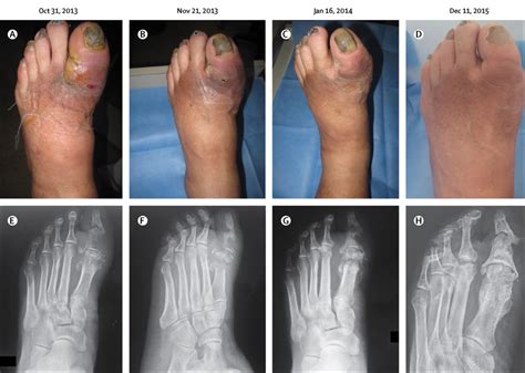 Non-surgical treatment of diabetic foot osteomyelitis - The Lancet Diabetes & Endocrinology