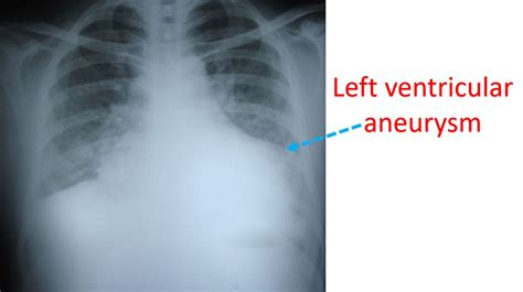 What is left ventricular aneurysm? – All About Heart And Blood Vessels