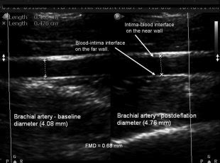 Ultrasound image of the brachial artery. Baseline diameter and ...