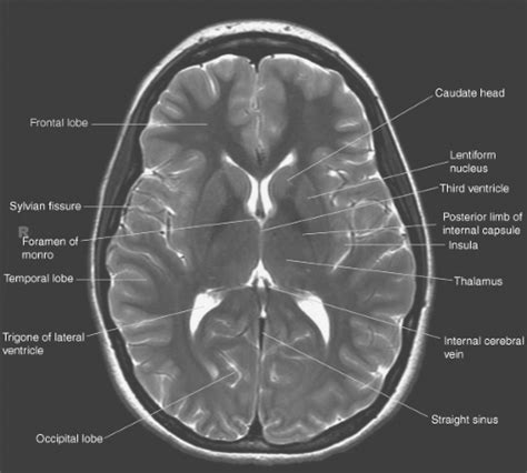 Introduction to Brain Imaging | Radiology Key