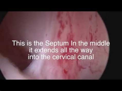 Uterine Septum Surgery by Dr. Andrea Vidali MD - YouTube