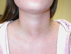 Scar After Thyroid Surgery. Minimally Invasive Thyroid Surgery, Alexander Shifrin, MD | www ...