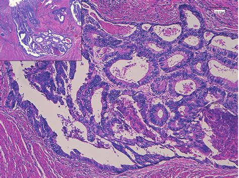 Adenocarcinoma Colon Histology