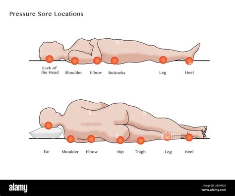 Ubicación de las úlceras por presión, diagrama Fotografía de stock - Alamy