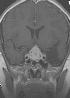 Lymphocytic Hypophysitis-MRI - Sumer's Radiology Blog