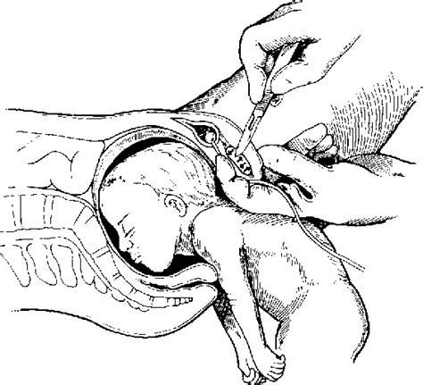 Figure 3 from Emergency Symphysiotomy for the Trapped Head in Breech ...