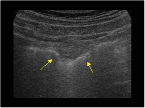 Abdomen and retroperitoneum | 1.7 Peritoneum mesentery and omentum : Case 1.7.1 Appendagitis ...