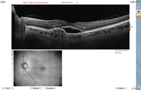 OCT angiography