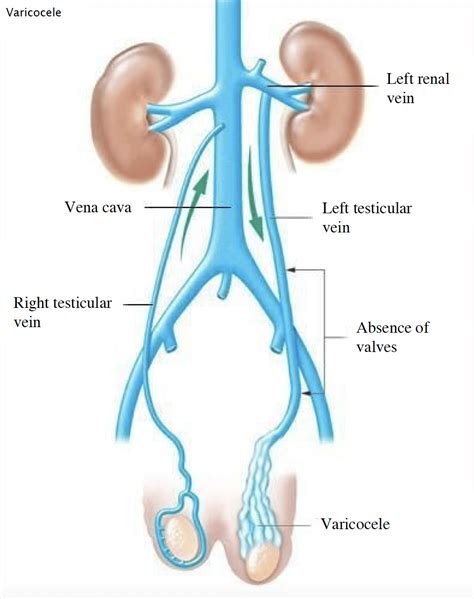 Varicocele - What is it, symptoms, treatment, embolization